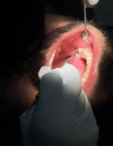 How long do dental implants last
